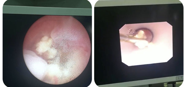 禹城市中医院成功开展第3例输尿管软镜结合钬激光碎石术