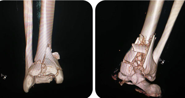 pilon骨折三型图片